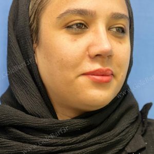 جراحی بینی گوشتی - فرم زیبا