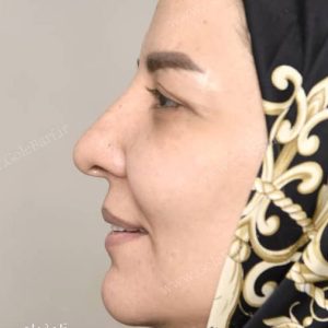 جراحی بینی گوشتی- کرج