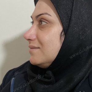 جراحی بینی استخوانی - با انحراف