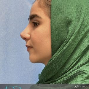 جراحی بینی استخوانی در تهران و کرج در مجموعه ی زیبایی گل برف