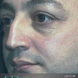 جراحی بینی استخوانی برای آقایان در تهران و کرج در مجموعه ی زیبایی گل برف