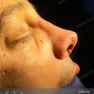 جراحی بینی استخوانی برای آقایان در تهران و کرج در مجموعه ی زیبایی گل برف