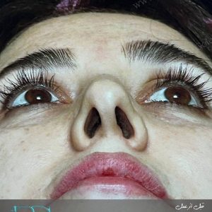جراحی بینی غضروفی برای آقایان در تهران و کرج در مجموعه‌ی زیبایی گل برف
