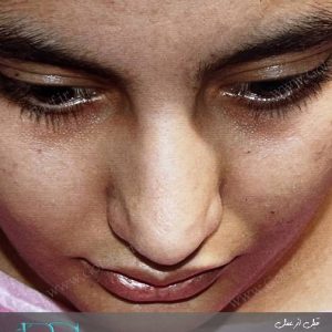 جراجی بینی گوشتی با نوک کج در تهران و کرج – مجموعه‌ی تخصصی گل برف