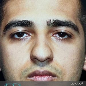 جراحی بینی گوشتی با نوک پهن برای آقایان در تهران و کرج
