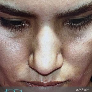 جراحی بینی گوشتی نامتقارن در تهران و کرج در مجموعه ی زیبایی گل برف