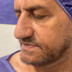 جراحی بینی گوشتی و نامتقارن برای آقایان در تهران و کرج در مجموعه‌ی زیبایی گل برف