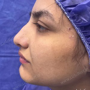 جراحی بینی گوشتی دارای قوز برای بانوان و آقایان در تهران و کرج در مجموعه‌ی زیبایی گل برف