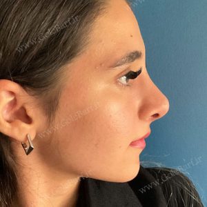 جراحی بینی غضروفی برای آقایان در تهران و کرج در مجموعه‌ی زیبایی گل برف