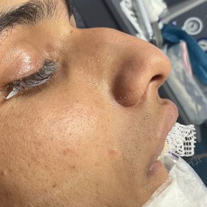 نتیجه ی عالی جراحی بینی استخوانی برای آقایان در تهران و کرج در مجموعه‌ی زیبایی گل برف