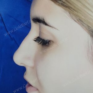جراحی بینی استخوانی دارای قوز ملایم برای بانوان در تهران و کرج در مجموعه‌ی زیبایی گل برف