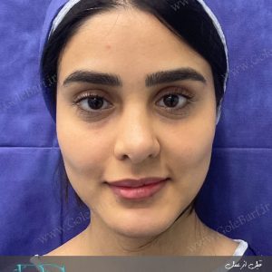 جراحی ترمیم بینی و انحراف برای بانوان در تهران و کرج در مجموعه‌ی زیبایی گل برف