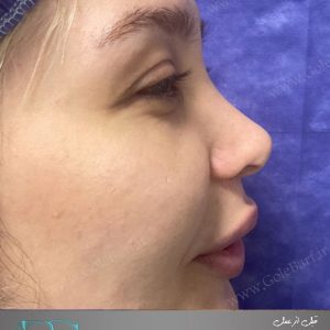 جراحی ترمیم انحراف نوک بینی برای بانوان در تهران و کرج در مجموعه‌ی زیبایی گل برف
