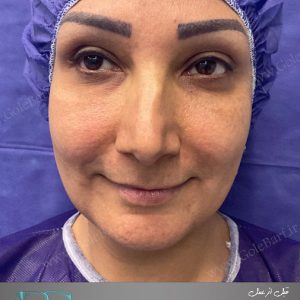 جراحی بینی استخوانی دارای انحراف برای بانوان در تهران و کرج در مجموعه‌ی زیبایی گل برف