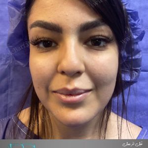 جراحی ترمیم افتادگی نوک بینی برای بانوان در تهران و کرج در مجموعه‌ی زیبایی گل برف