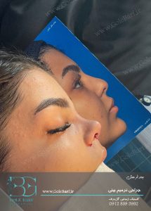 جراحی ترمیم افتادگی نوک بینی برای بانوان در تهران و کرج در مجموعهی زیبایی گل برف