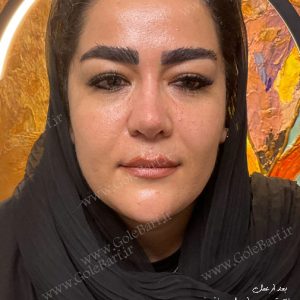 جراحی بینی گوشتی و نامتقارن برای بانوان و آقایان در تهران و کرج در مجموعه ی زیبایی گل برف