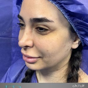 جراحی ترمیم بینی برای بانوان در تهران و کرج در مجموعه‌ی زیبایی گل برف
