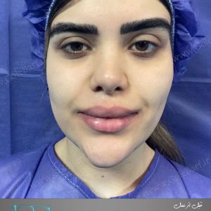 جراحی ترمیم بینی برای بانوان در تهران و کرج در مجموعه‌ی زیبایی گل برف