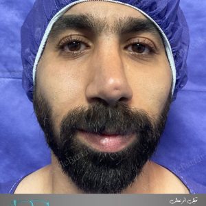 ترمیم بینی برای آقایان در تهران و کرج در مجموعه‌ی زیبایی گل برف