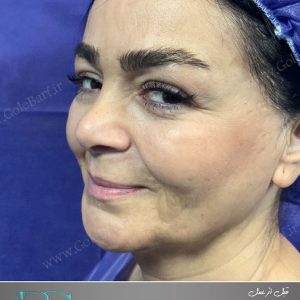 جراحی ترمیم بینی و سانترال لب برای بانوان در تهران و کرج در مجموعه‌ی زیبایی گل برف